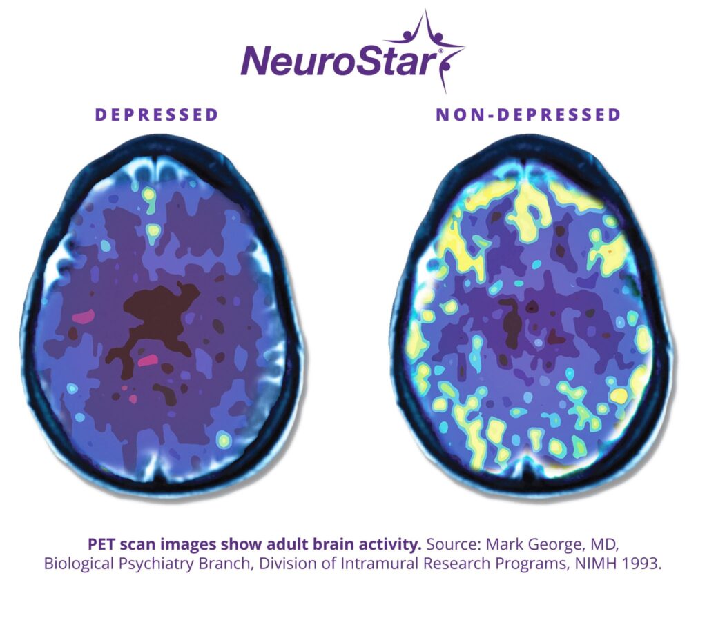 NeuroStar PET scan comparing depressed vs non-depressed brain activity to understand how much does TMS therapy cost value.