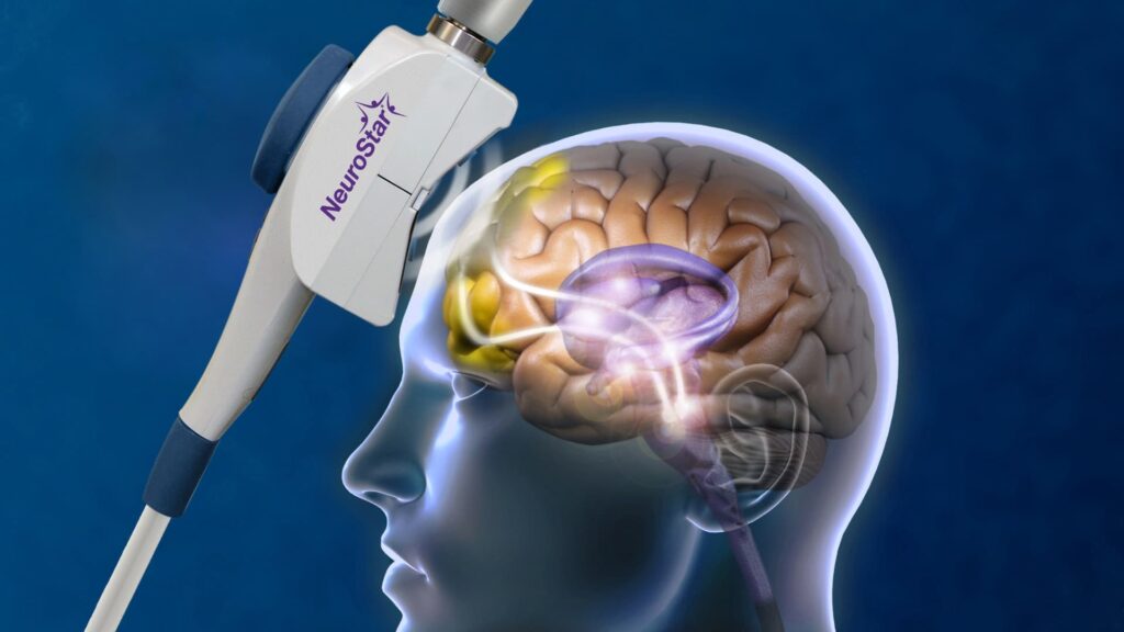 What are the long-term side effects of TMS? NeuroStar device delivers magnetic pulses to targeted brain regions.